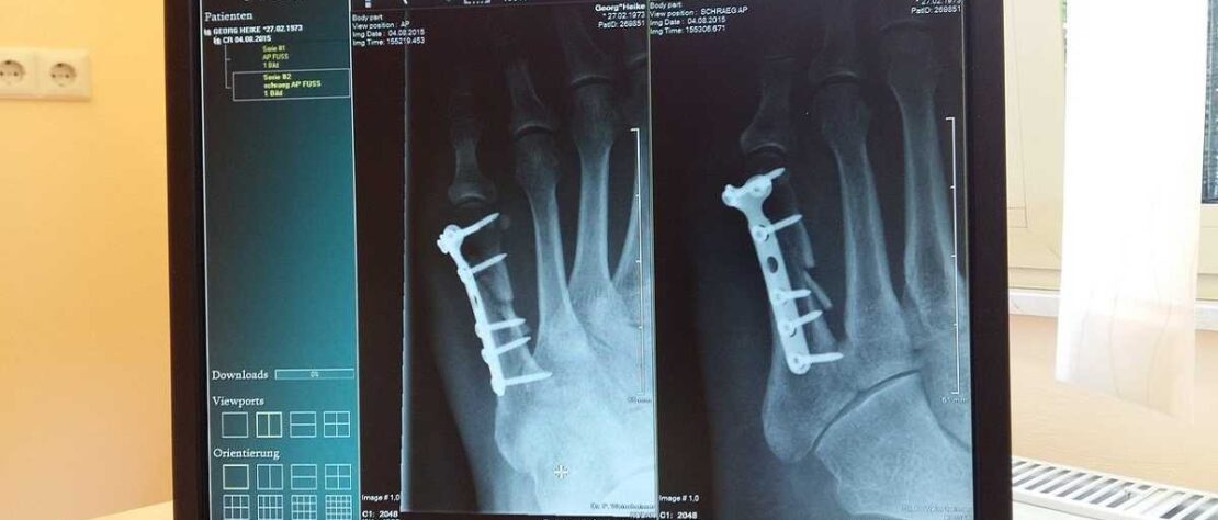 a x-ray of fractured bone